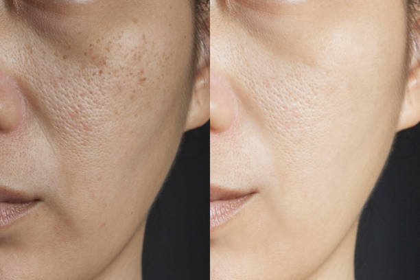 Before And After - Eyes