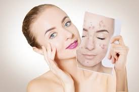 Acne Solutions