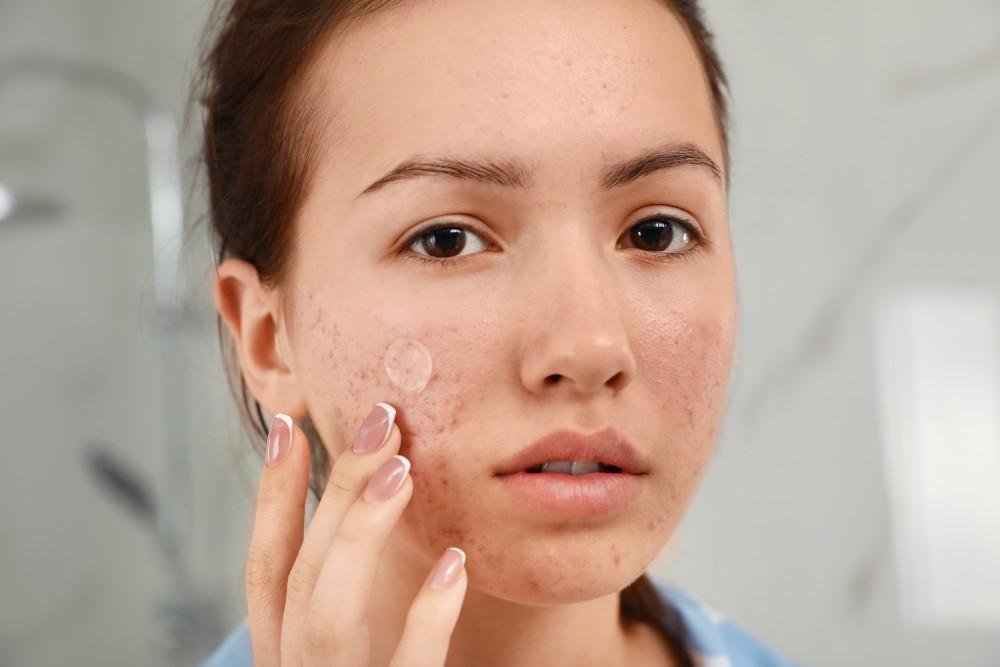 Acne-Free Skin