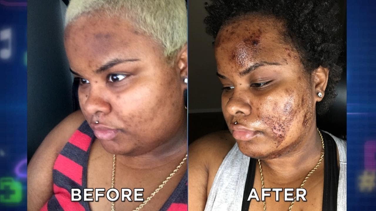Chemical Peels